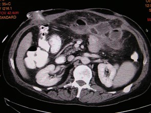 readmit w fever-fat necrosis