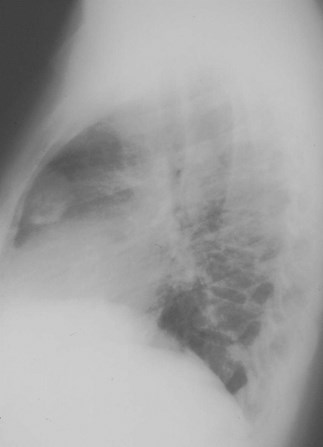 C:\WINDOWS\DESKTOP\photos\infection\fungal diseases\coccidiodoma acute\cocci lat.jpg