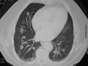G:\photos\infection\fungal diseases\coccidioidomycosis CT.jpg