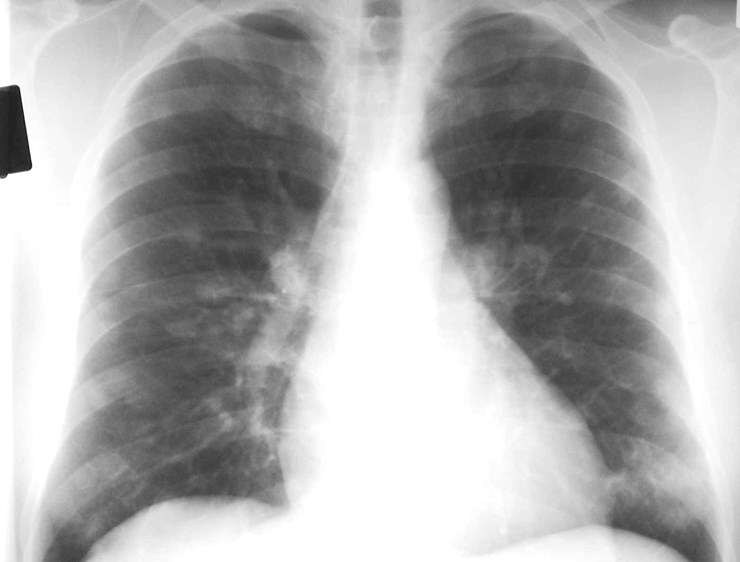 C:\WINDOWS\DESKTOP\photos\infection\fungal diseases\histo acute irizarry\pa acute.jpg
