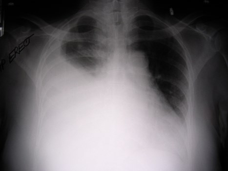 G:\photos\infection\Tuberculosis\tuberculous effusion\pa.jpg