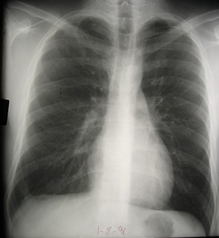 G:\photos\infection\Tuberculosis\primary RUL, eff\pa 2.JPG
