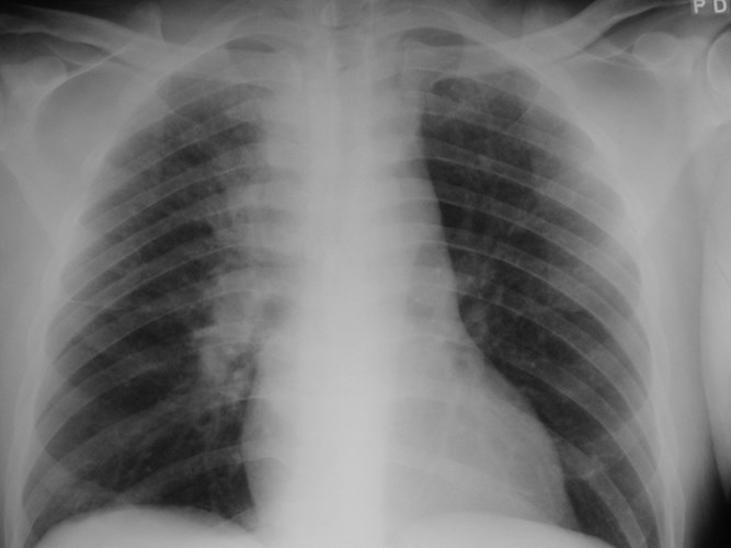 G:\photos\infection\Tuberculosis\TB disseminated in AIDS\TB disseminated AIDS cxr.jpg