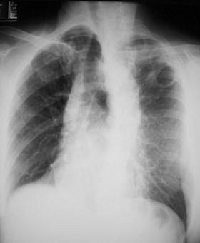 G:\photos\infection\Tuberculosis\TB LUL cavity faint RUL nodule\LAO.JPG.JPG