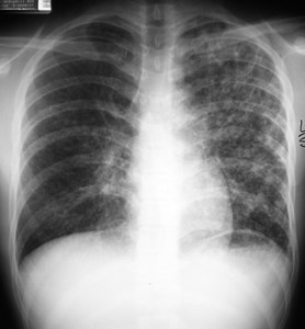 G:\photos\infection\Tuberculosis\TB Sok HRCT T-I-B\pa.JPG