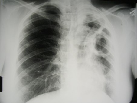 G:\photos\infection\Tuberculosis\TB LUL collapse LLL cavity\pa.JPG