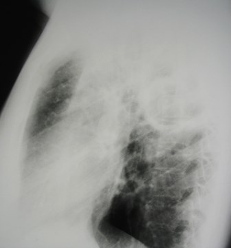 G:\photos\infection\Tuberculosis\TB LUL collapse LLL cavity\lat.JPG