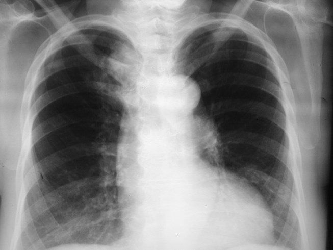 G:\photos\infection\Tuberculosis\TB clavicle sign\TB clav sign RUL PA.jpg