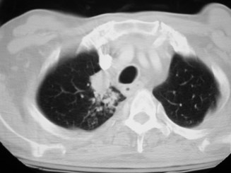 G:\photos\infection\Tuberculosis\RUL reactivation simulates Ca\ct2.JPG