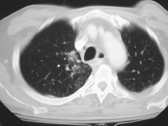 G:\photos\infection\Tuberculosis\RUL reactivation simulates Ca\ct3.JPG
