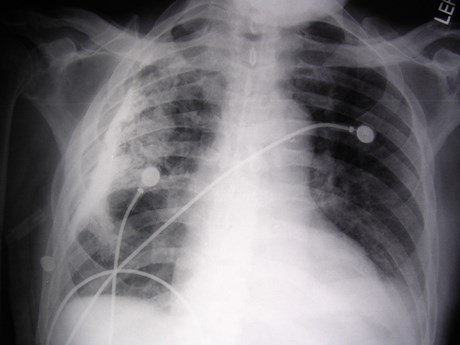 G:\photos\infection\Tuberculosis\pleural cloak.JPG