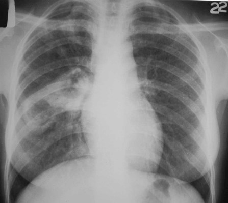 G:\photos\infection\Tuberculosis\TB cavitary with miliary spread\pa.JPG