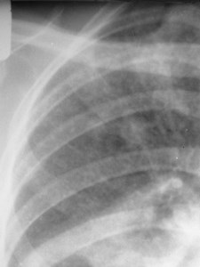 G:\photos\infection\Tuberculosis\TB cavitary with miliary spread\DSCN0022(8).JPG
