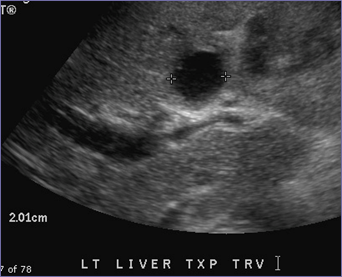 3 intrahept PSA MRN 100290619.jpg