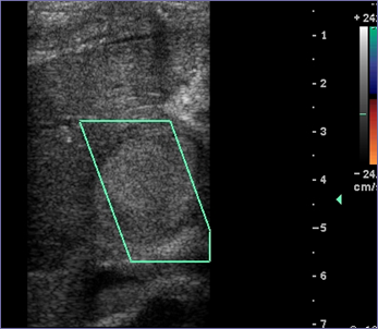 5 post thrombin.jpg