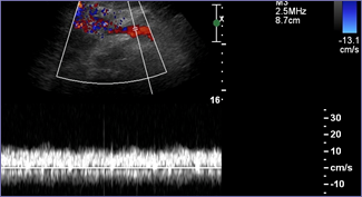 pre stenosis normal velocities.jpg