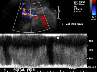 post stenosis high velocities.jpg