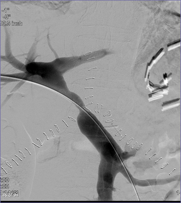 angio PV stenosis.jpg