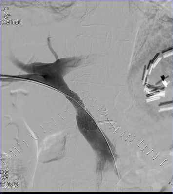 PV stent.jpg