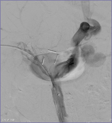 large varices.jpg
