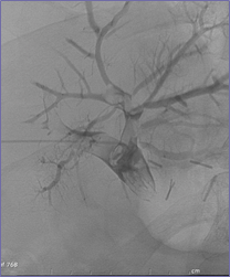 cavagram w thrombus.jpg