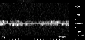 trace PV flow on Doppler.jpg