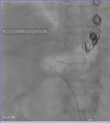 embolization of varices.jpg