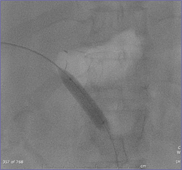 angioplasty of PV.jpg