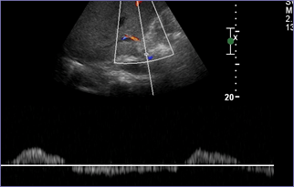 US PV Post op Day 2 trace bidirectional flow.jpg