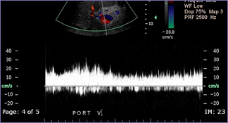 intra op improved PV after ligation varices.jpg