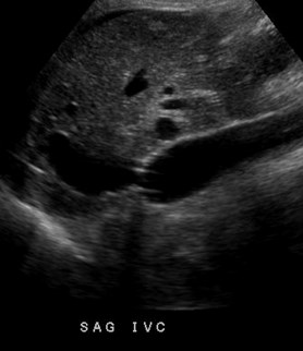 sag IVC.jpg