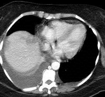 CT -4 IVC thrombus