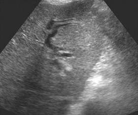 US dilated l lobe ducts-5