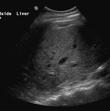 US R lobe 1.jpg