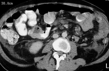 lymphoma-CT-5