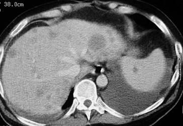 lymphoma-CT-4