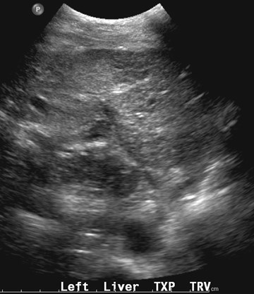 Day 1 US, abn L lobe