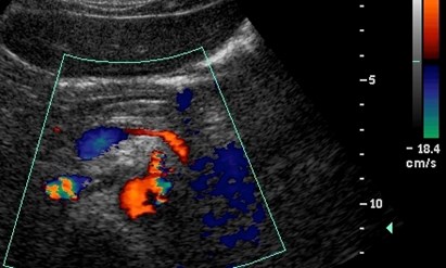 splenic v