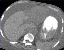 CT 3-17 necrotic l lobe