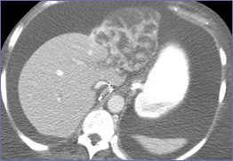 CT 3-22 w contrast