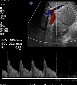 13 days RHA stenosis.jpg