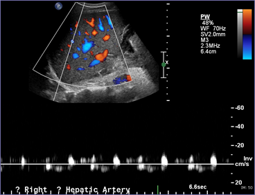 10 13 days RHA stenosis.jpg
