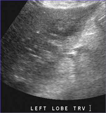 po day 15 HAT abn l lobe trv
