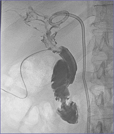 cholangiogram 3-29-06