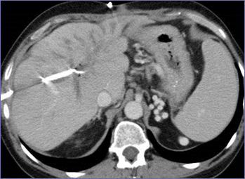 CT 8-17, biloma gone, diffuse PV thrombosis, varices