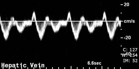 R HEP V pulsed DOppler.jpg
