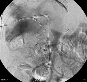 PV phase with PV thrombosis