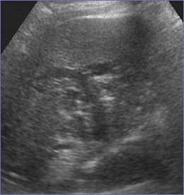 Dilated ducts RLobe 12-6