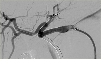 post stent angio.jpg