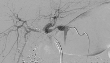 selective HA inject w stenosis.jpg